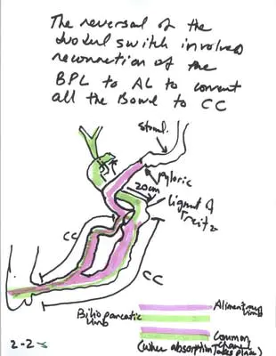 image1799-min Reversal of Duodenal Switch