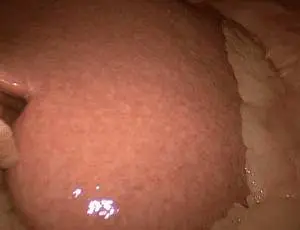 liver-failure-01