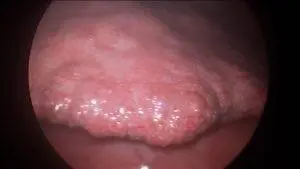 liver-failure-03