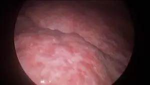 liver-failure-05