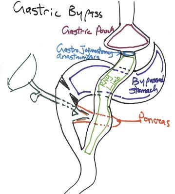 Gastro-gastric fistula after gastric bypass operation