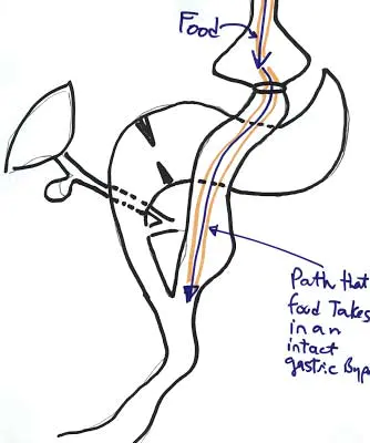 image0005 alt="Gastro-gastric fistula after gastric bypass operation"