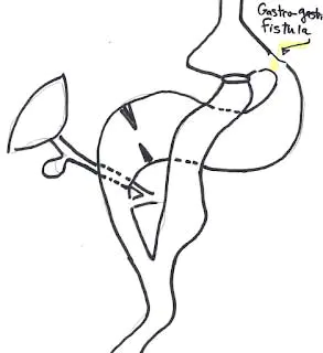 image0006 Gastro-gastric fistula after gastric bypass operation