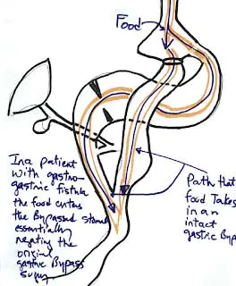 image0007 Gastro-gastric fistula after gastric bypass operation