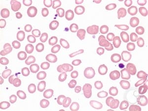 iron anemia deficiency blood smear cells pencil microcytic ida patient red low film hypochromic stepwards slides mcv loss rbcs dssurgery