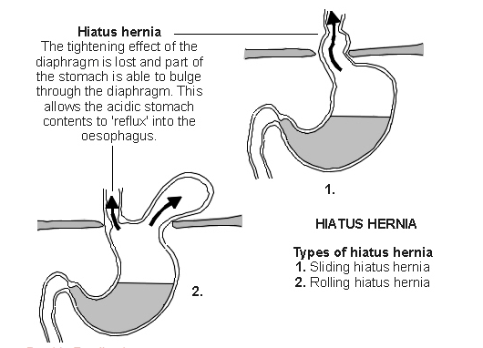 Hiatal Hernia Types