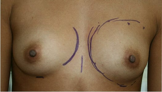 Before-Mammaplasty (Breast Augmentation)