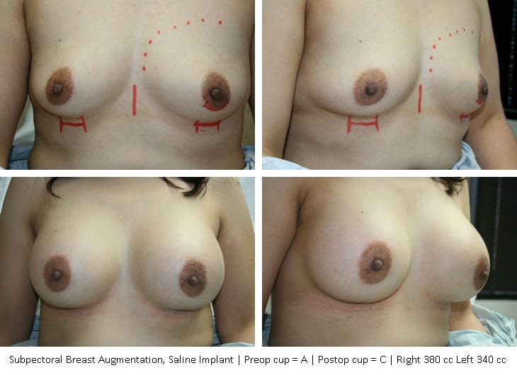 breast-augmentation-01