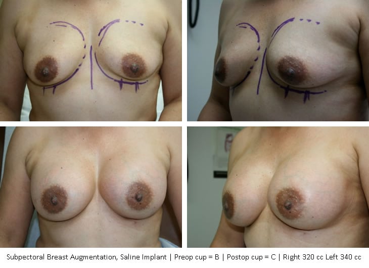 breast-augmentation-02