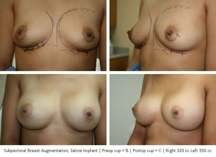 breast-augmentation-04