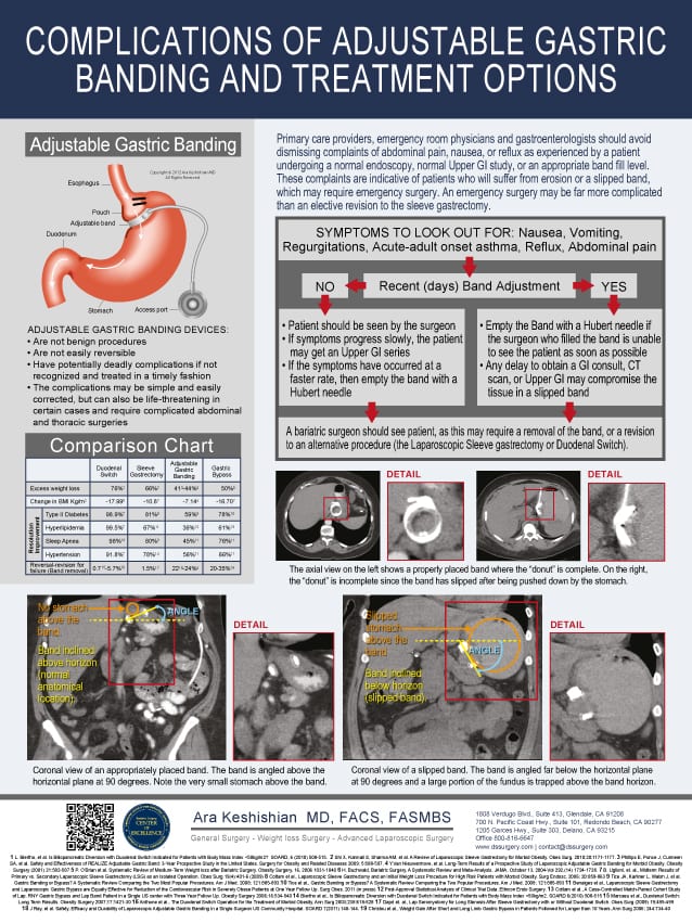 Adjustable Gastric Banding Complications Poster