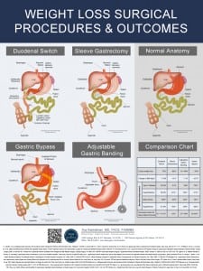 Weight Loss Surgical Procedures Poster