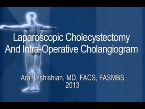 Laparoscopic Cholecystectomy and Intra-Operative Cholangiogram