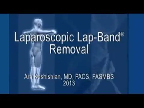 Laparoscopic Lap-Band® Removal