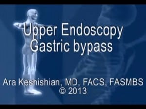 Upper Endoscopy Gastric Bypass