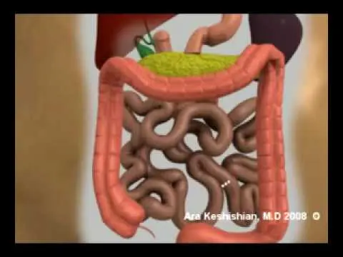 Duodenal Switch Operation