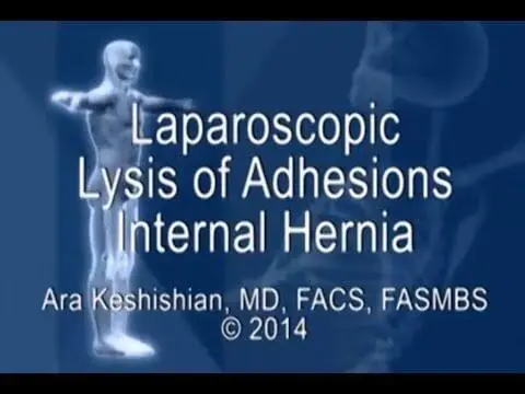 Laparoscopic Lysis of Adhesions - Internal Hernia