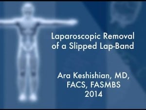 Laparoscopic Removal of a Slipped Band