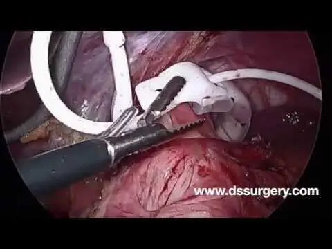 Lap Band Removal
