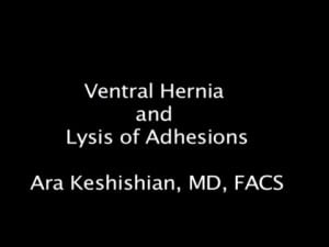 Abdominal Wall hernia, internal hernia