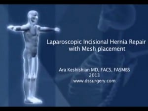 Laparoscopic Incisional Hernia Repair with Mesh Placement