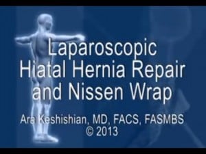 Laparoscopic Hiatal Hernia Repair and Nissen Wrap