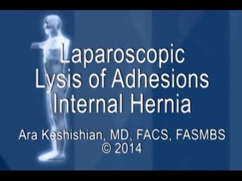Laparoscopic Lysis of Adhesions - Internal Hernia