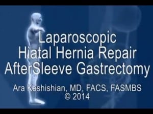 Laparoscopic Hiatal Hernia Repair after Sleeve Gastrectomy