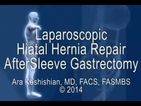 Laparoscopic Hiatal Hernia Repair after Sleeve Gastrectomy