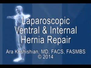 Laparoscopic Ventral and Internal Hernia Repair