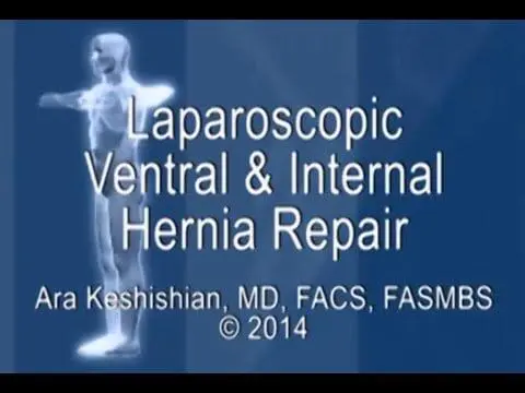 Laparoscopic Ventral and Internal Hernia Repair