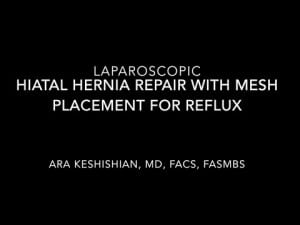 Laparoscopic Hiatal Hernia with Mesh Placement