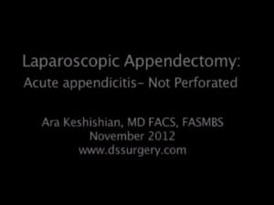 Laparoscopic Appendectomy #1