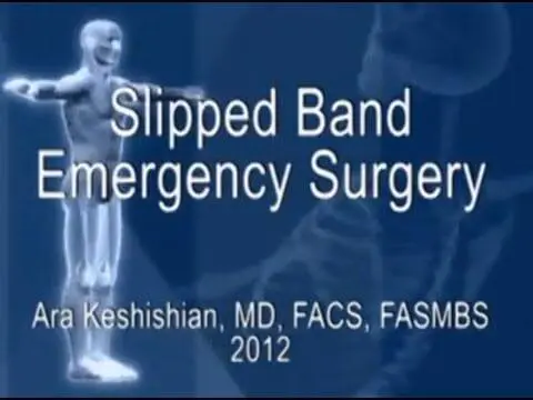 Slipped Adjustable Gastric Band removal