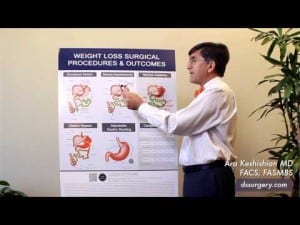 Weight Loss Surgical Procedures Part 2- Sleeve Gastrectomy