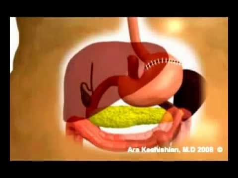 Reversal of RNY-gastric bypass