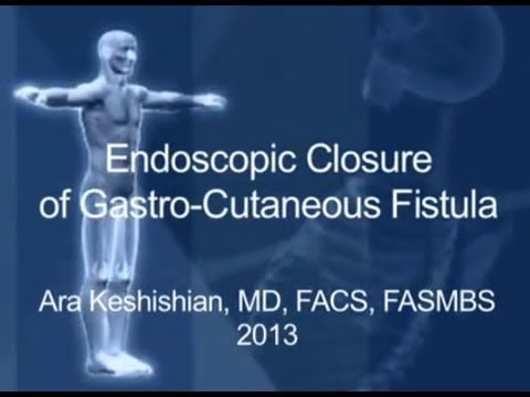 Endoscopic Closure of Gastro-Cutaneous Fistula