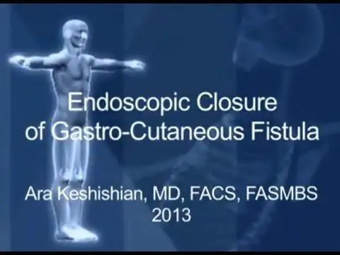 Endoscopic Closure of Gastro-Cutaneous Fistula