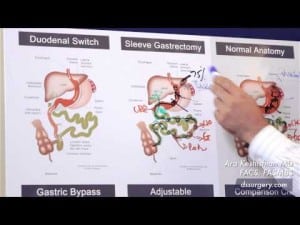 Weight Loss Surgical Procedures Part 3 - Ghrelin (overly simplified)