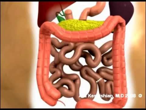 Gastric Bypass to Duodenal Switch