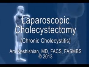 Laparoscopic Cholecystectomy - Chronic Cholecystitis