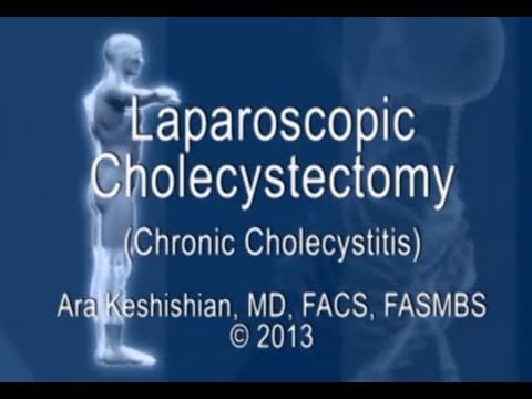 Laparoscopic Cholecystectomy - Chronic Cholecystitis