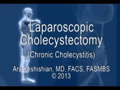 Laparoscopic Cholecystectomy - Chronic Cholecystitis