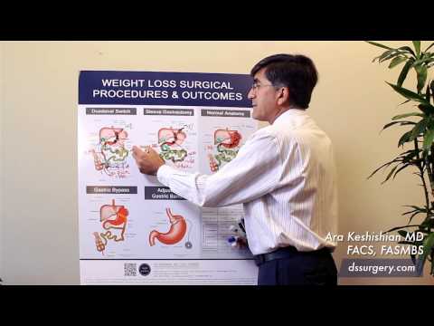 Weight Loss Surgical Procedures Part 4 - Duodenal Switch