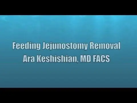 Feeding Jejunostomy Removal