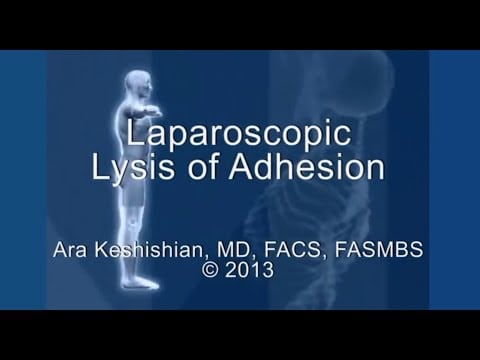 Laparoscopic Lysis of Adhesion