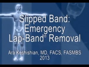 Slipped Band: Emergency Lap-Band® Removal