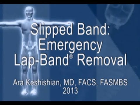 Slipped Band: Emergency Lap-Band® Removal