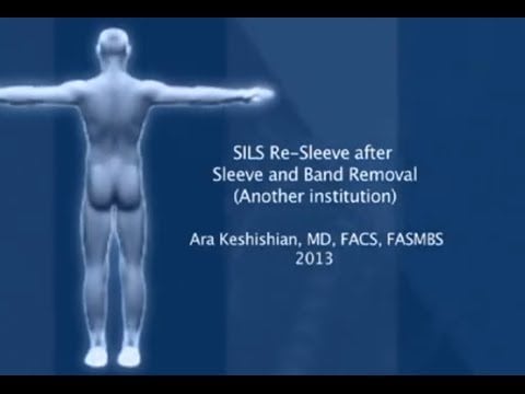 SILS™ Re-Sleeve after Sleeve and Band Removal