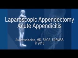 Laparoscopic Appendectomy #2